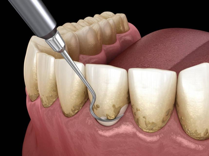 Periodontitis