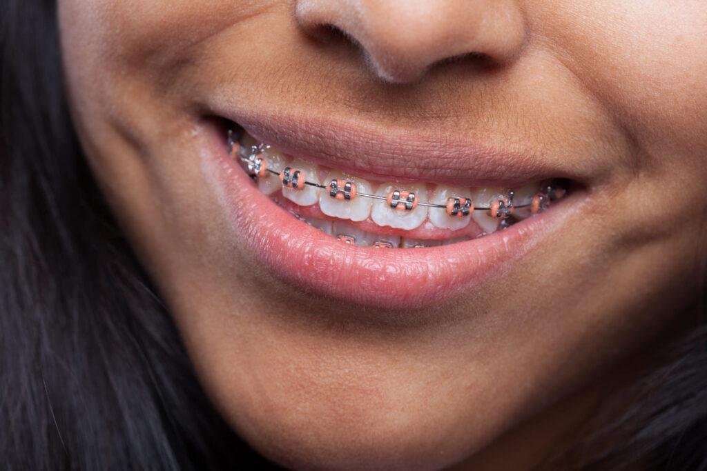 ortodoncia invisible o brackets