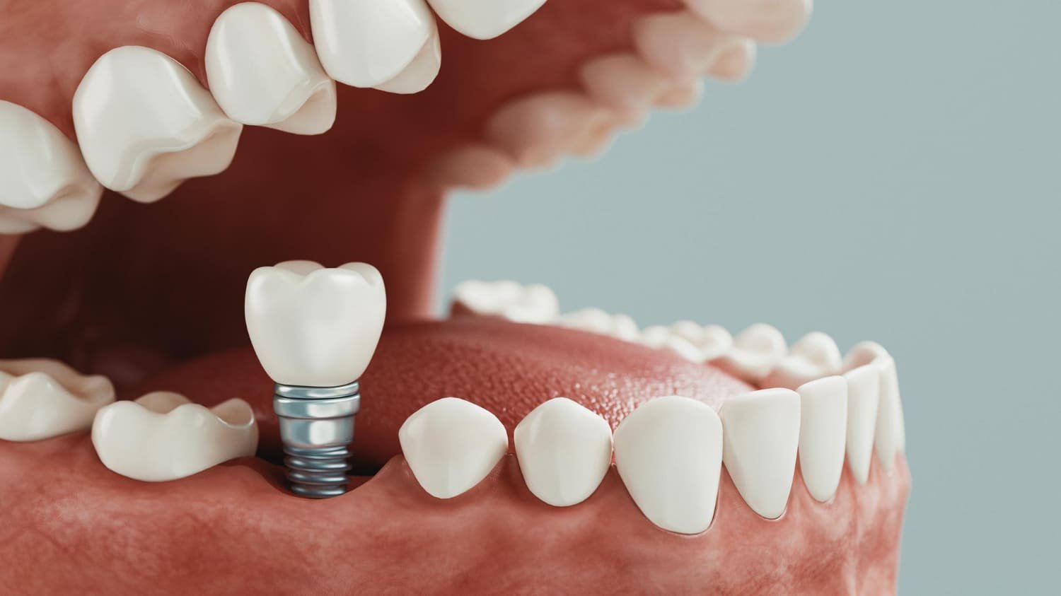 cuántos implantes dentales se pueden poner en un día