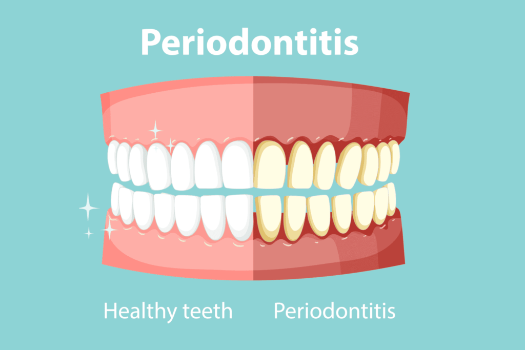que es la piorrea dental