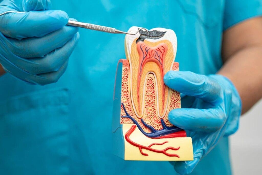 qué es una endodoncia en una muela
