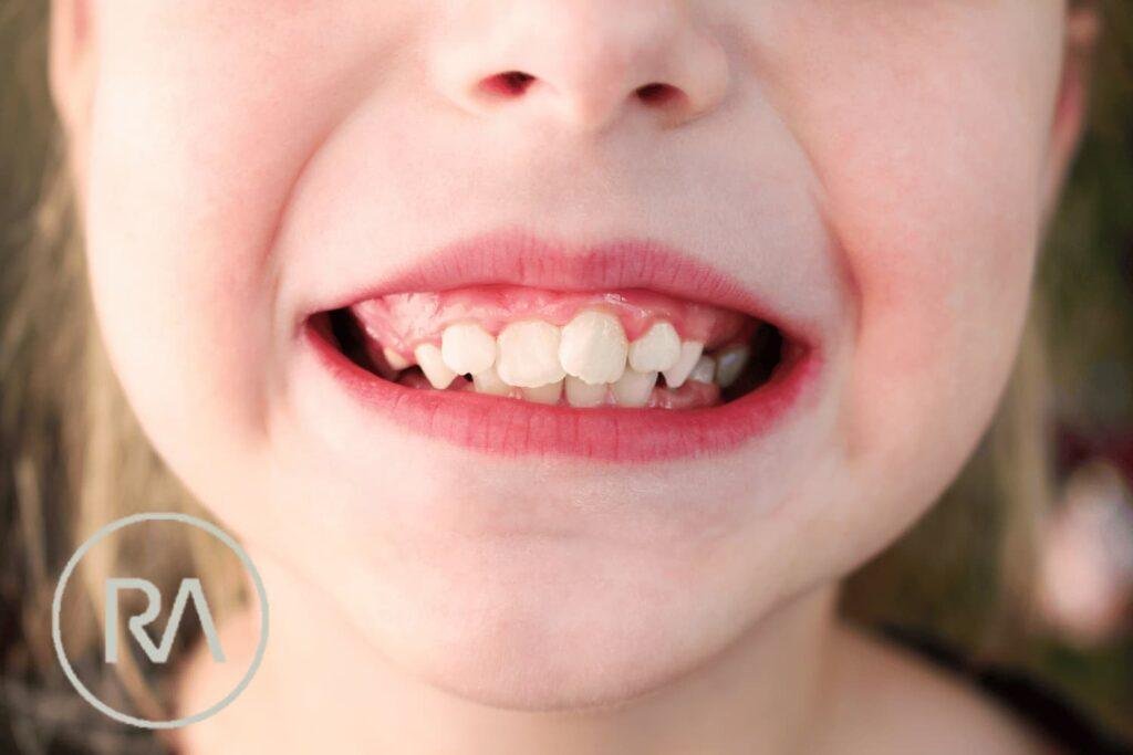 Dents apinyades
