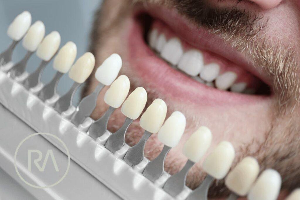 Quant costen les carilles dentals